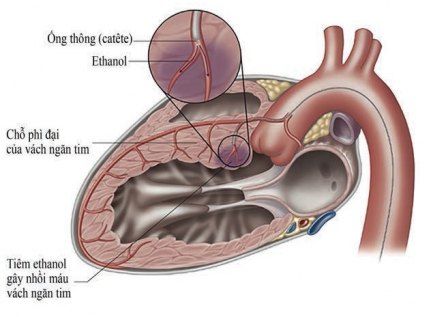 Hình 2: Kỹ thuật tiêm cồn vào động mạch nuôi vách liên thất