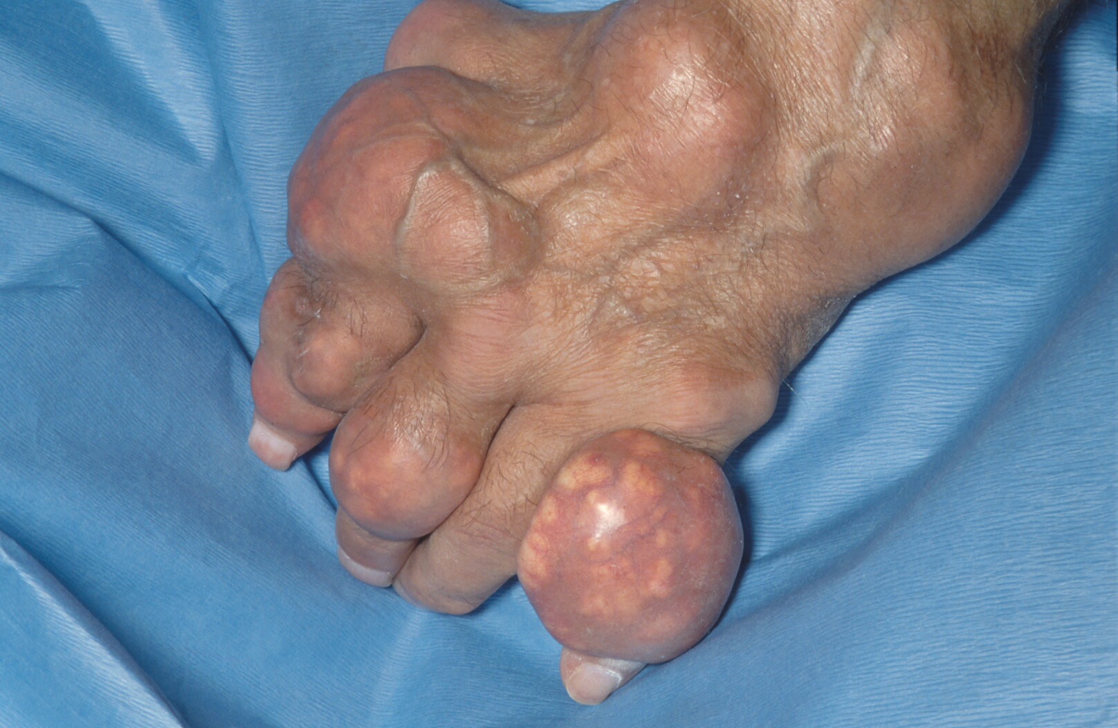 Hình ảnh các hạt tophi dưới da ở người bệnh gout