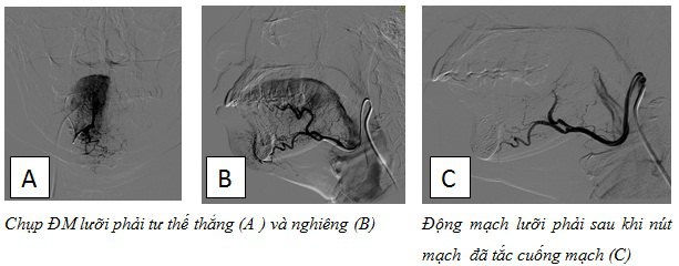 Hình 1: hình ảnh chụp động mạch lưỡi bên phải trước và sau nút mạch bằng hạt PVA
