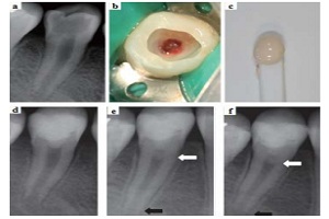 Điều trị tủy răng sống với xi măng Calcium silicate