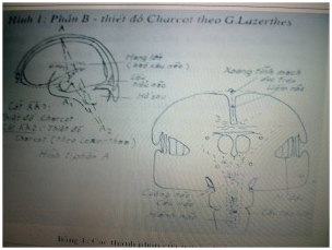Hình 1.  Thiết đồ Charcot cho thấy các thành phân của não