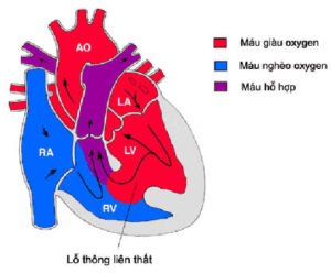Thông liên thất là một trong những dị tật bẩm sinh của tim