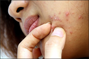 Một số bệnh ngoài da thường gặp mùa hè.