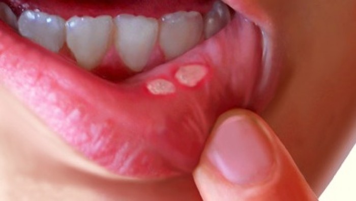 Chứng lở miệng có thể do vi khuẩn, virus ...gây ra