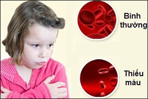 Thiếu máu ở trẻ em