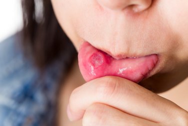 Lở miệng gây khó chịu cho người bệnh 