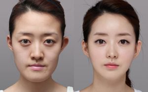 Hình ảnh so sánh trước và sau khi phẫu thuật thẩm mỹ