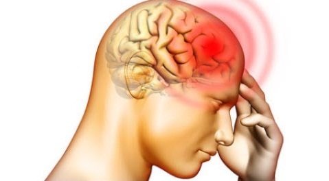 Nhức đầu vùng trán là dấu hiệu thường gặp trong hội chứng màng não