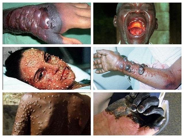 Một số hình ảnh kinh khủng của bệnh Ebola. (Nguồn: Internet).