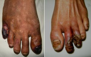 Bệnh tắc động mạch mạn tính chi dưới gây hoại tử các ngón chân