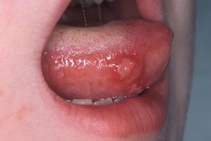 Vết loét miệng có thể làm trẻ đau đớn ăn kém
