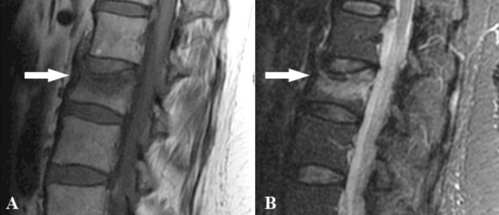 Hình ảnh lún xẹp đốt sống trên phim chụp cộng hưởng từ MRI