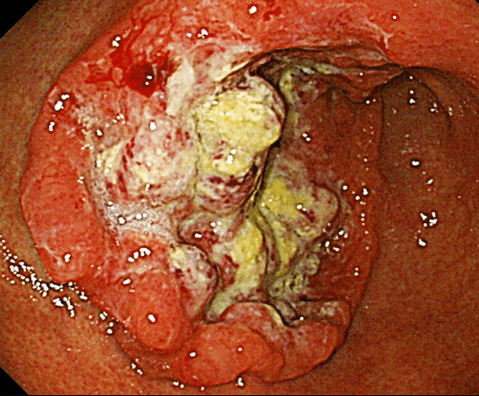 Hình ảnh ung thư dạ dày qua nội soi