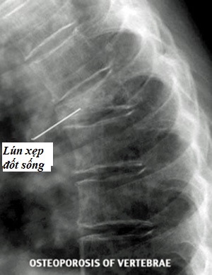 Hình ảnh loãng xương trên phim chụp X - quang