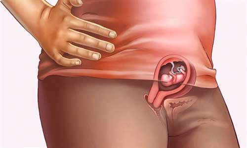 Bệnh trĩ có thể gặp ở phụ nữ khi mang thai