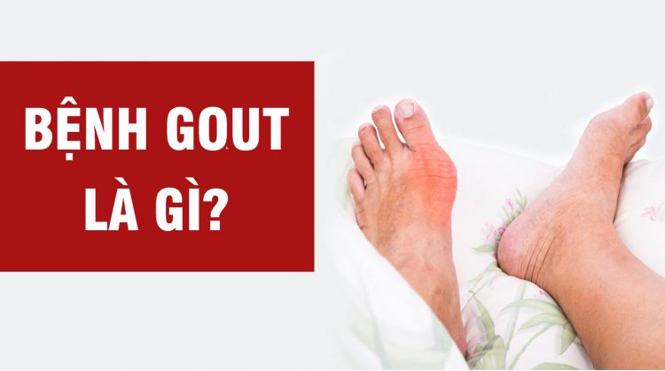 Trang bị những kiến thức cơ bản về bệnh gout cũng là một cách phòng ngừa bệnh