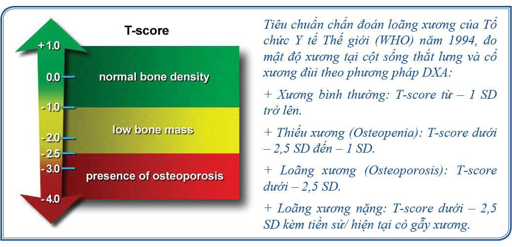 Chẩn đoán loãng xương dựa vào mật độ xương T-score