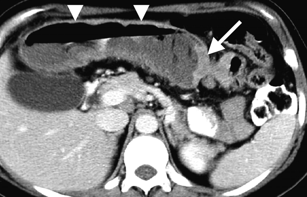 Hình ảnh ung thư đại tràng trên phim chụp CT ổ bụng.