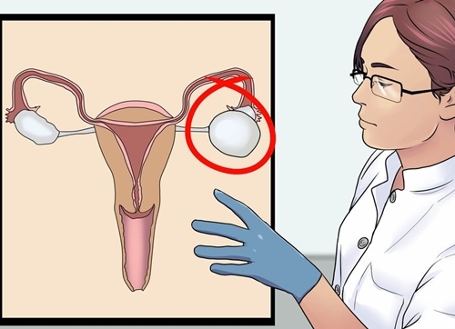 Điều trị u nang buồng trứng