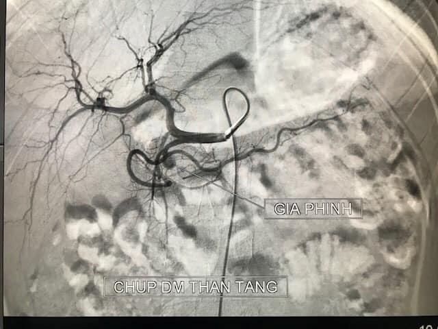 Hình ảnh ổ giả phình lớn động mạch vị tá tràng ở bệnh nhân