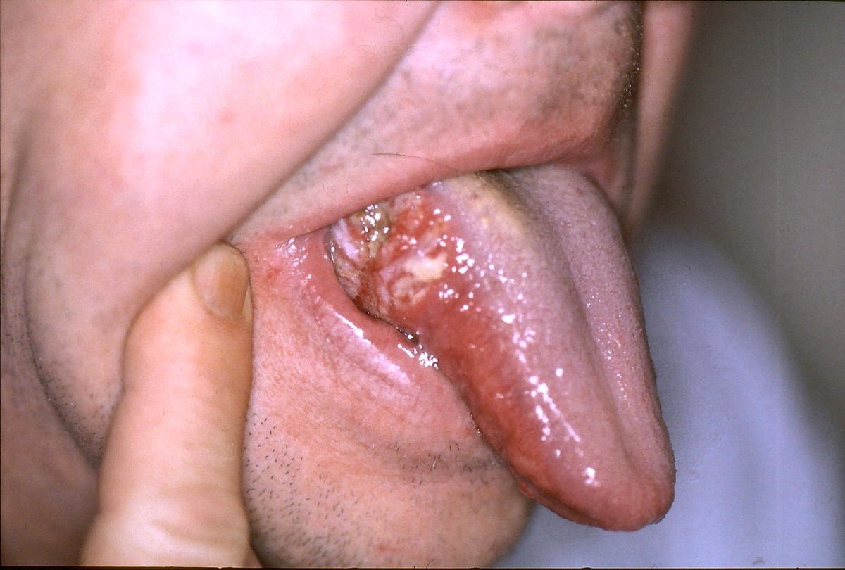 Ung thư lưỡi là bệnh ác tính nguy hiểm tới tính mạng.