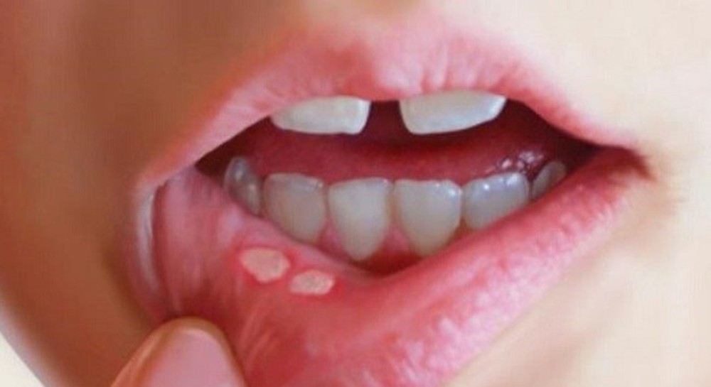 Triệu chứng của nhiệt miệng là các vết loét