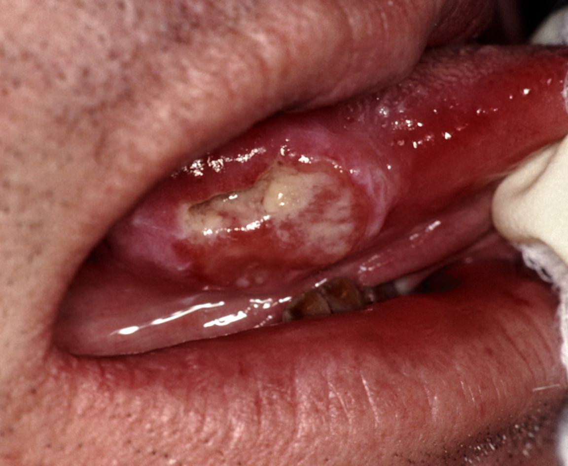 Hình ảnh ung thư lưỡi