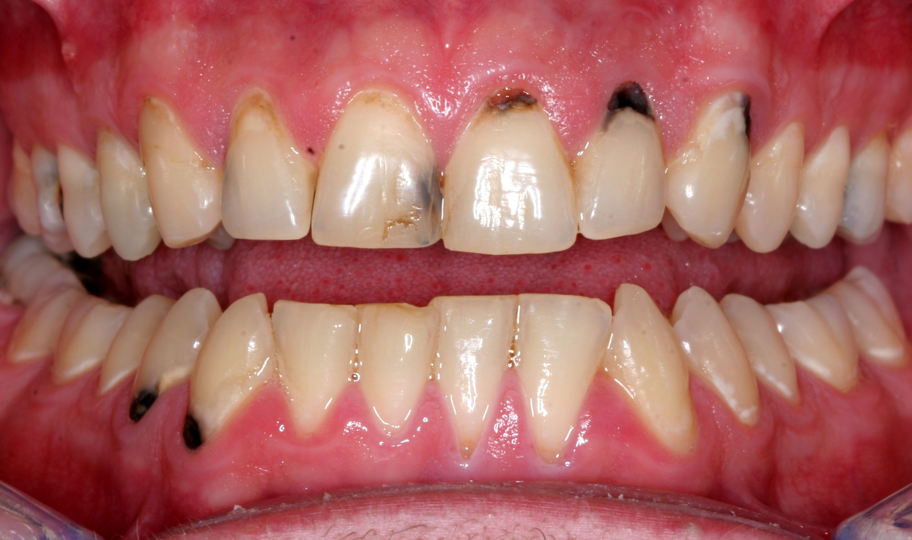 Viêm lợi sau khi bọc răng sứ là tình trạng khá phổ biến