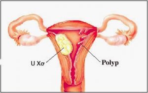 Rong kinh ở phụ nữ tiền mãn kinh có thể do viêm nhiễm, polyp cổ tử cung hoặc các bệnh lý ác tính