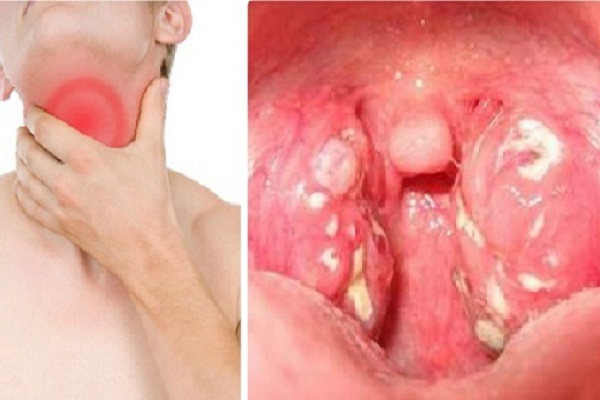 Dấu hiệu sớm của ung thư vòm họng phát hiện như thế nào?