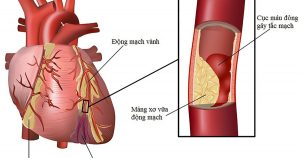 Hình ảnh: Nguyên nhân gây nhồi máu cơ tim (Internet)