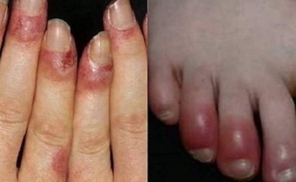 Hình ảnh: Bệnh cước chân tay (Internet)