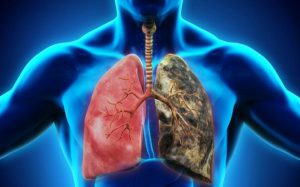 ung thư phổi ở nam giới