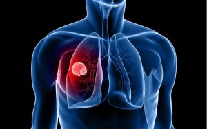 Rất khó phát hiện ung thư phổi ở giai đoạn sớm
