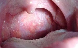 Ung thư vòm họng là tình trạng các khối u phát triển trong cổ họng