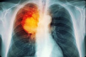 Triệu chứng ung thư phổi giai đoạn cuối