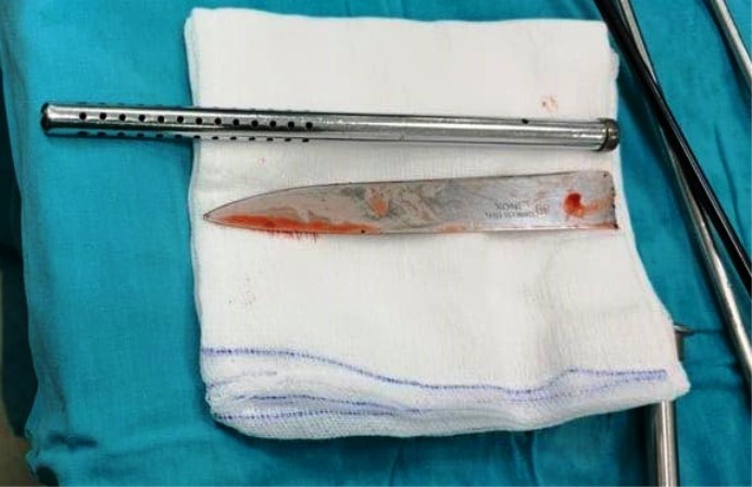 Lưỡi dao Thái Lan dài 25 cm được các bác sĩ "nín thở" rút ra khỏi cơ thể bệnh nhân 