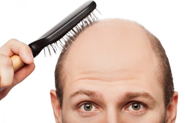 "Ngân hàng" tóc đầu tiên trên thế giới trị hói đầu từ các nang tóc được lưu trữ khi tóc còn chắc khỏe