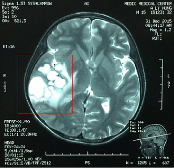 Hình ảnh tổ sán trong não bệnh nhân