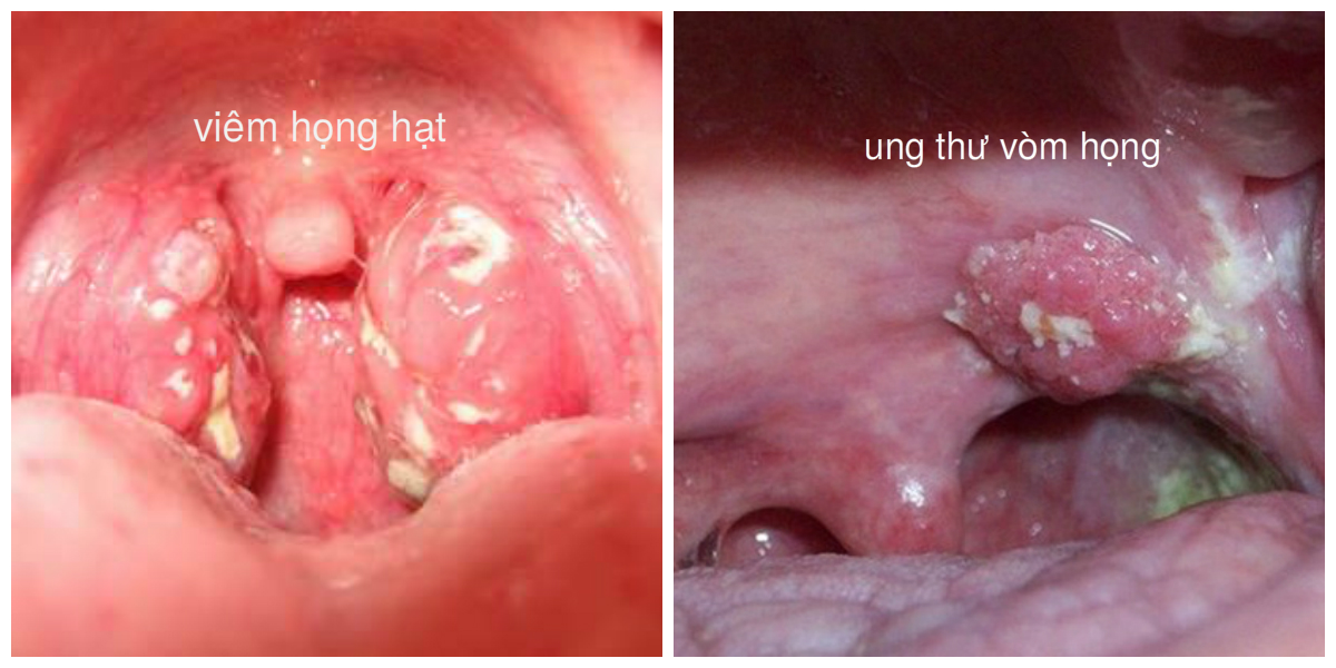 Hình ảnh: Viêm họng hạt và Ung thư vòm họng (Internet)