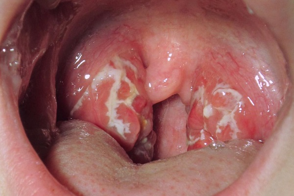 Ung thư vòm họng có triệu chứng gì?
