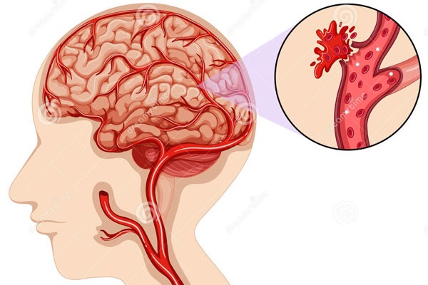 Xuất huyết não là gì? Những điều cần biết về xuất huyết não