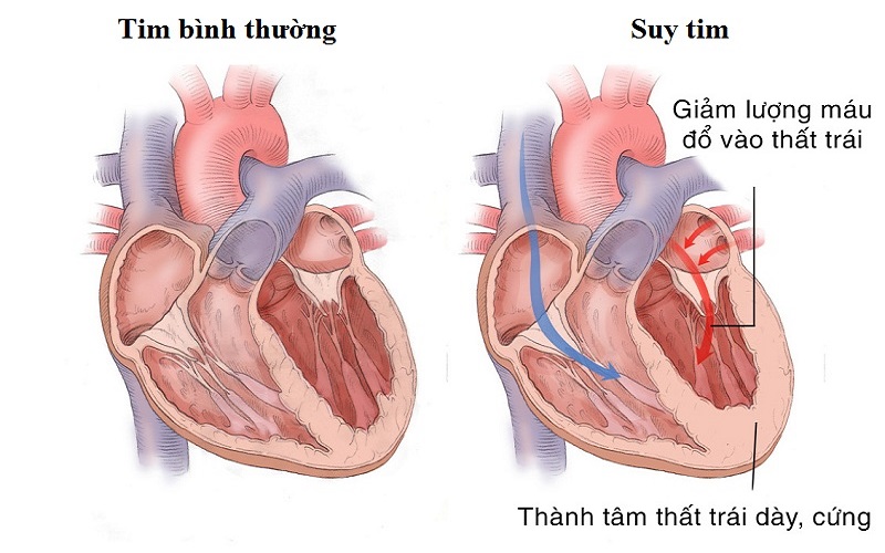 Suy tim sẽ gây giảm lượng máu qua tim đi nuôi cơ thể và kiến cơ tim dày lên