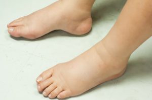 Phù chân là triệu chứng thường gặp ở người bị suy tim phải