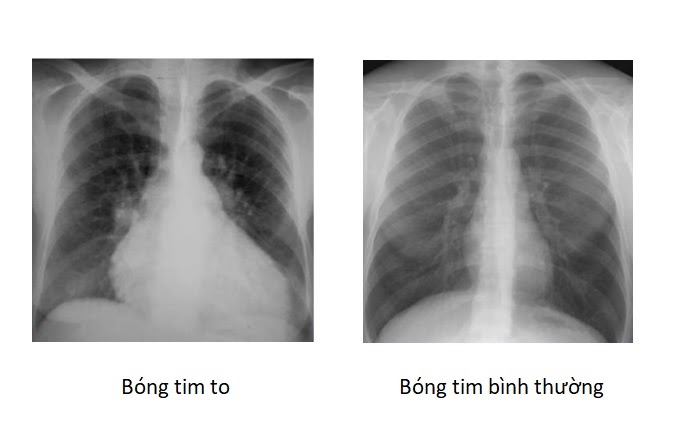 Hình ảnh bóng tim to trên X quang ngực là dấu hiệu của bệnh tim mạch
