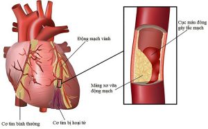 Thiếu máu cơ tim nếu không phát hiện và điều trị sớm sẽ trở nên nghiêm trọng