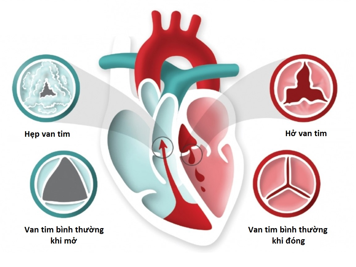 Nhiều người bệnh băn khoăn hở van tim có chữa được không