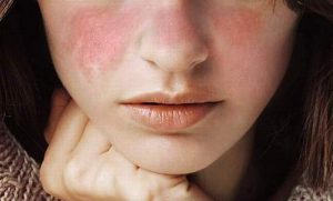 Bệnh lupus ban đỏ sống được bao lâu?