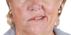 Méo miệng là một trong những di chứng thường gặp sau tai biến