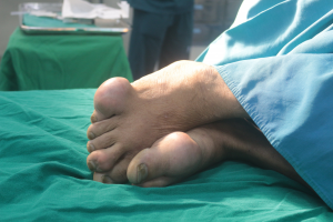 Biến dạng bàn chân do mắc gout
